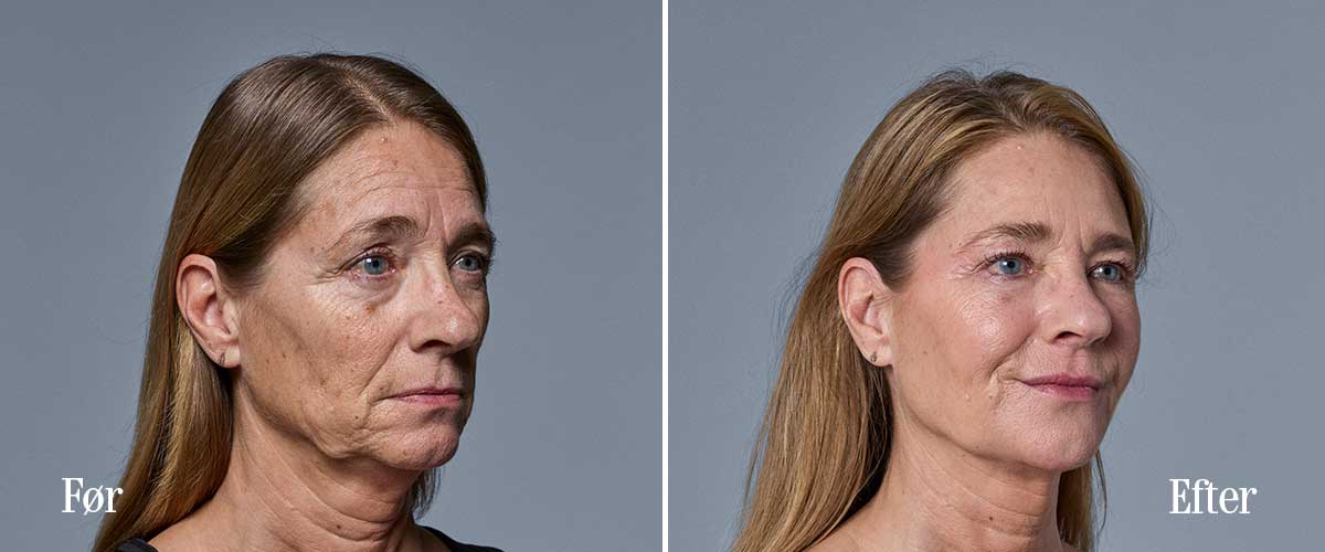Retouch Clinic signaturbehandling
